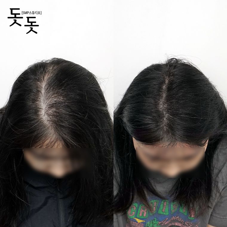 여성 정수리·가르마 두피문신 전후 사례 2