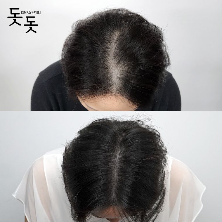 여성 정수리·가르마 두피문신 전후 사례 4