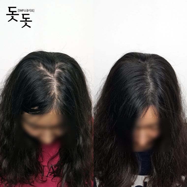 여성 정수리·가르마 두피문신 전후 사례 5