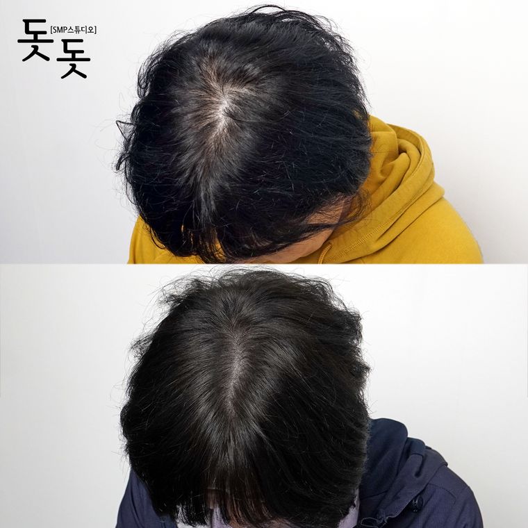 여성 정수리·가르마 두피문신 전후 사례 9