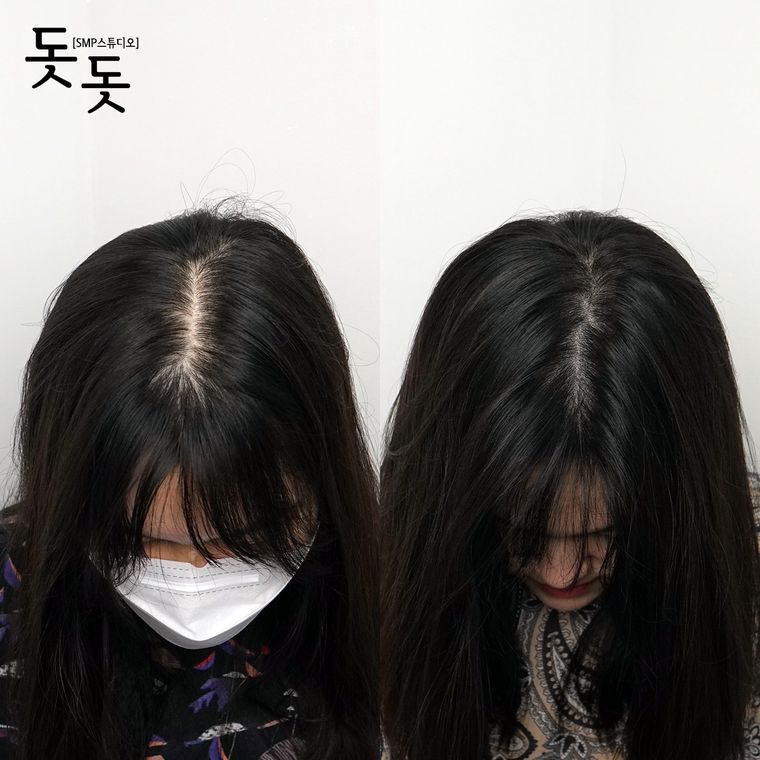 여성 정수리·가르마 두피문신 전후 사례 11