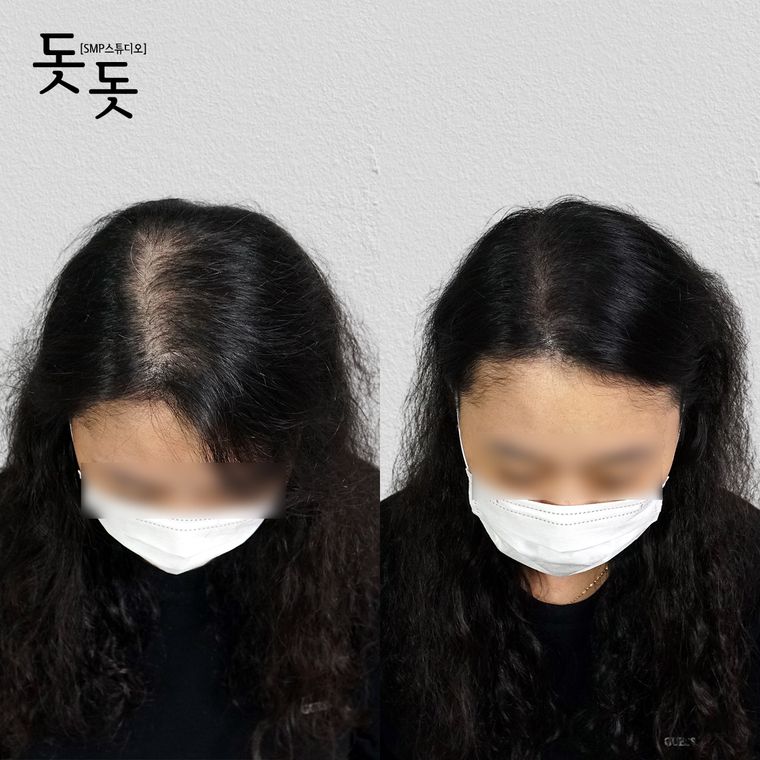 여성 정수리·가르마 두피문신 전후 사례 18
