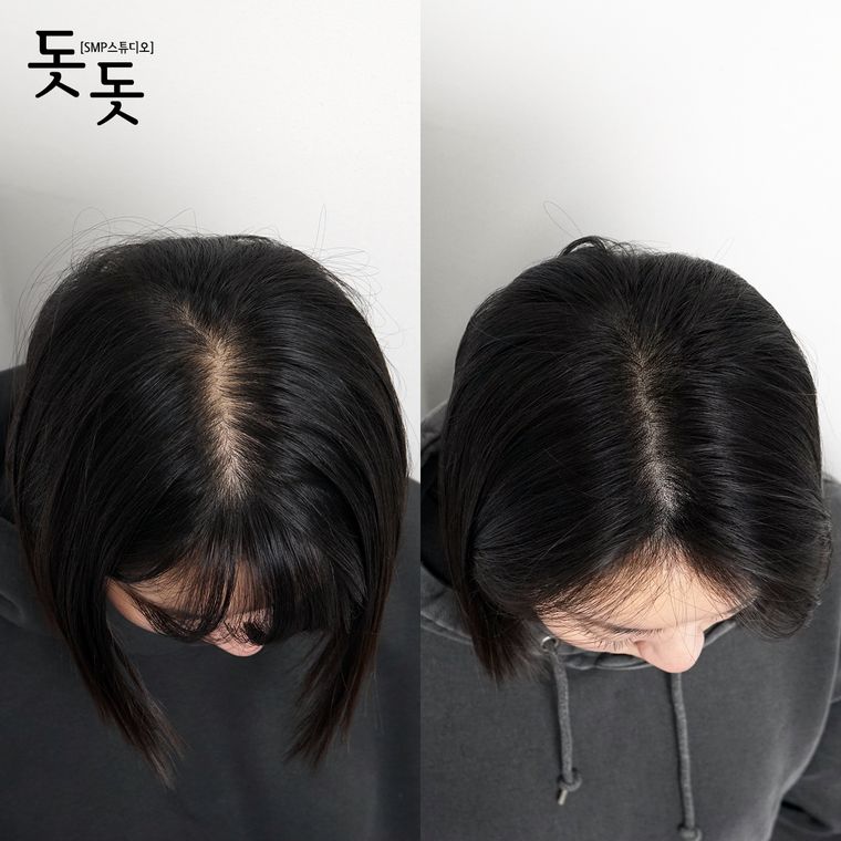 김포두피문신 여성 정수리·가르마 커버 시술 전후 사례