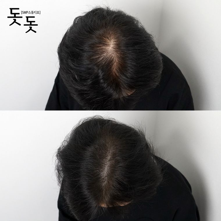 여성 정수리·가르마 두피문신 전후 사례 20