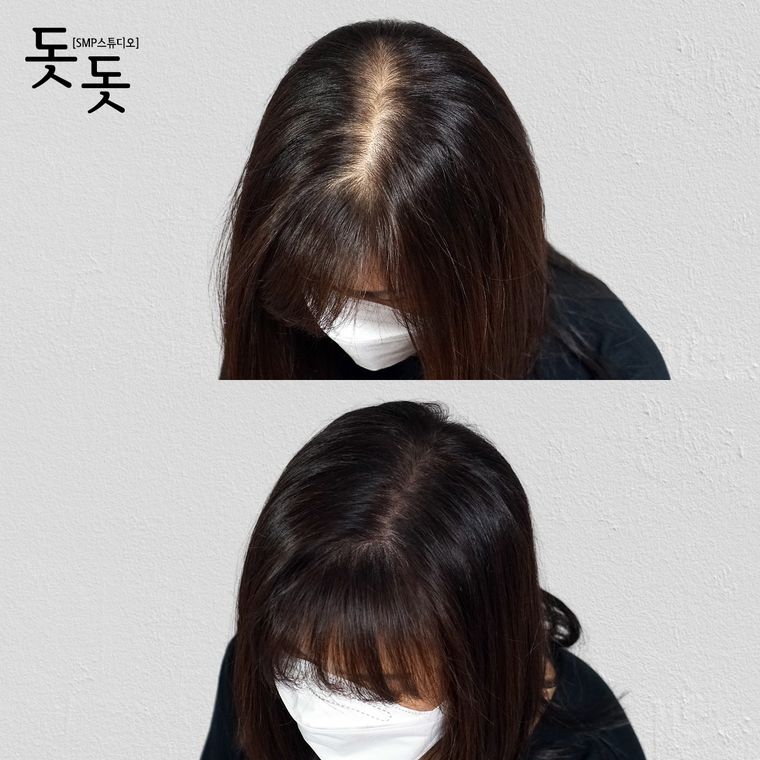 여성 정수리·가르마 두피문신 전후 사례 22