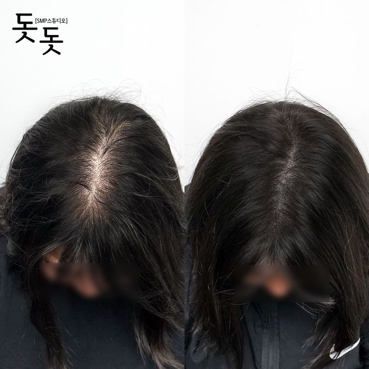 여성 정수리·가르마 두피문신 전후 사례 24