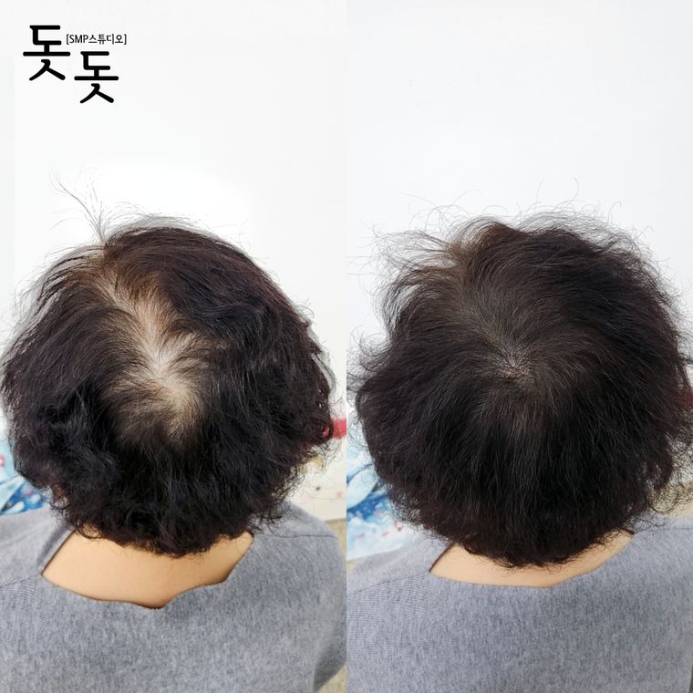 여성 정수리·가르마 두피문신 전후 사례 26