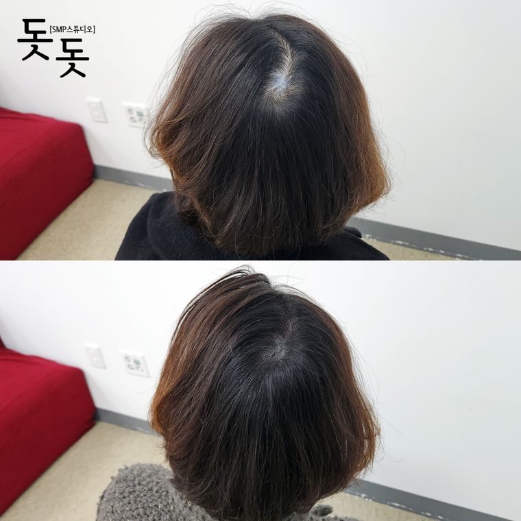 여성 정수리·가르마 두피문신 전후 사례 27