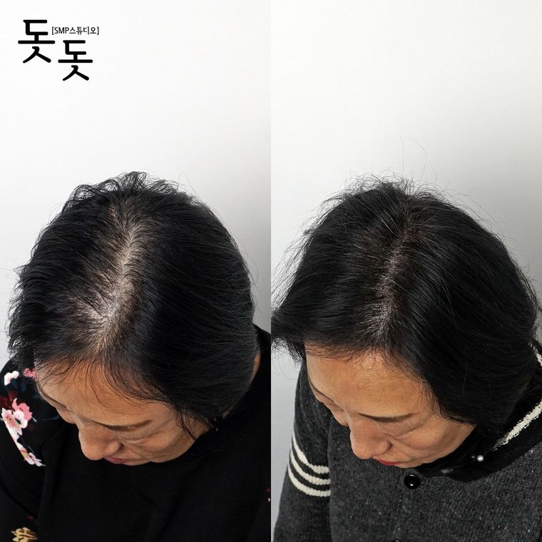 여성 정수리·가르마 두피문신 전후 사례 28