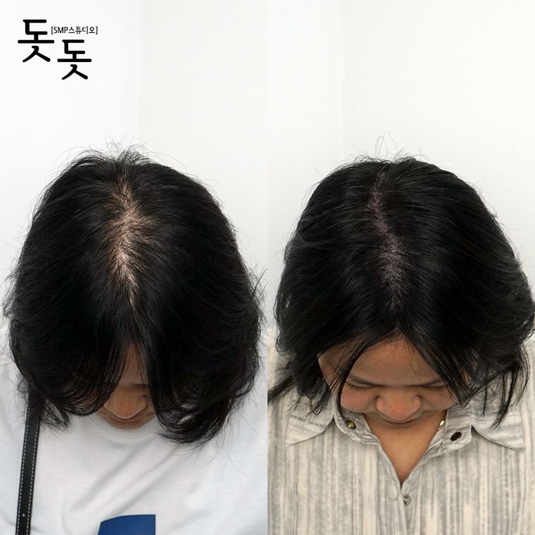 여성 정수리·가르마 두피문신 전후 사례 29