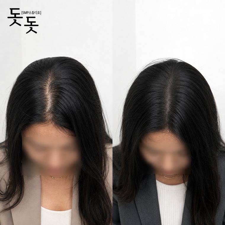 여성 정수리·가르마 두피문신 전후 사례 37