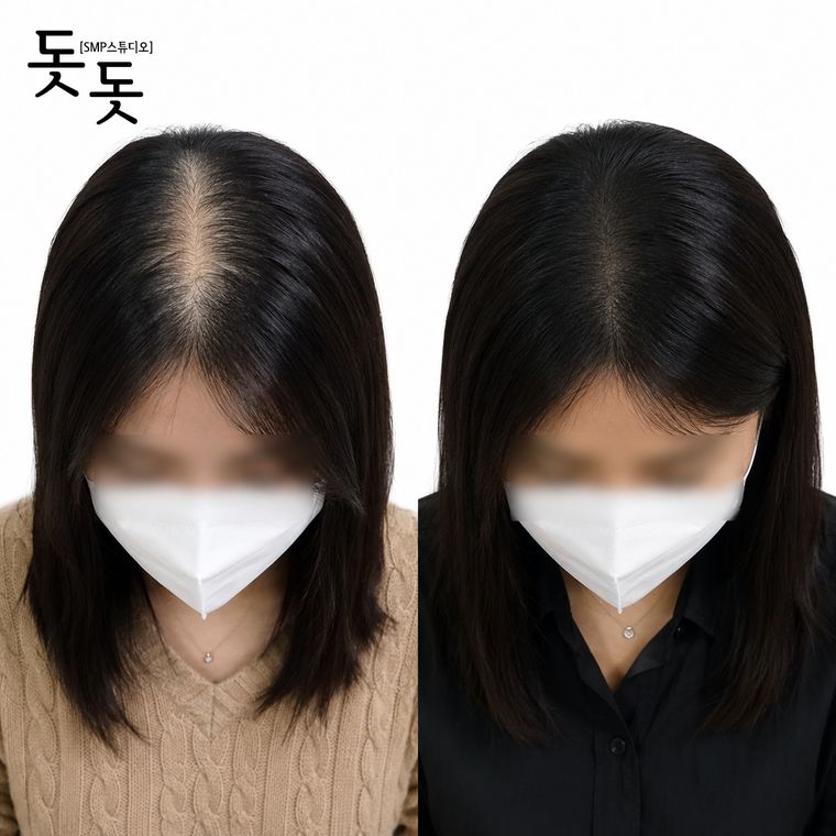 여성 정수리·가르마 두피문신 전후 사례 39