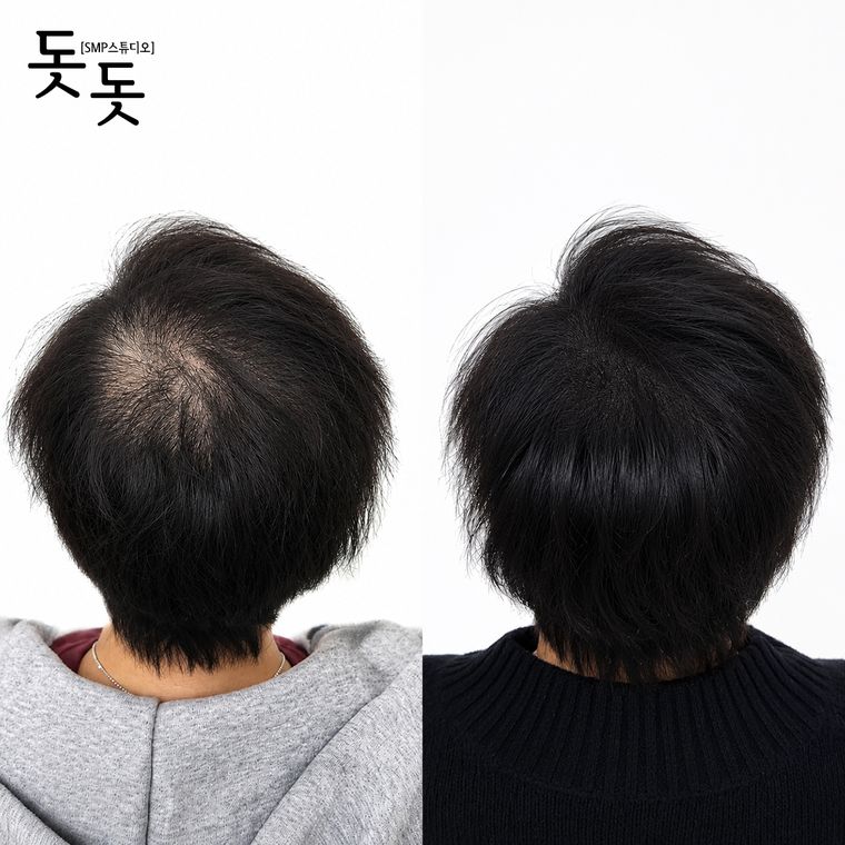 구월동두피문신 여성 정수리·가르마 커버 시술 전후 사례