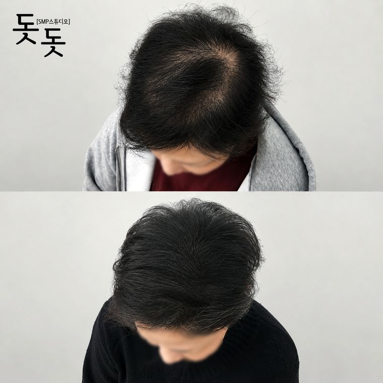 여성 정수리·가르마 두피문신 전후 사례 43