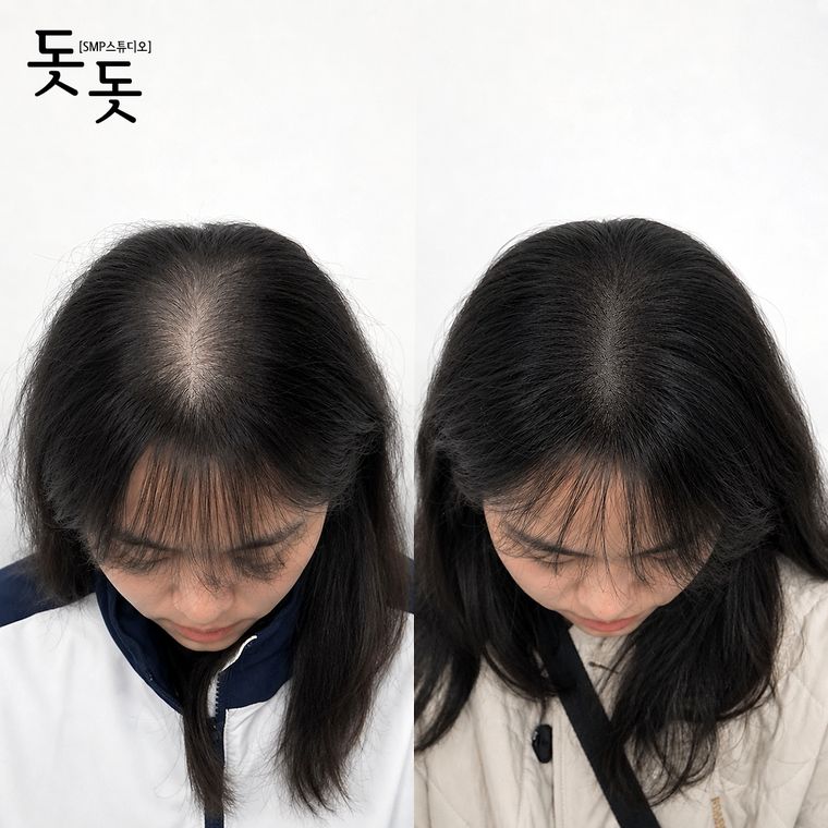 여성 정수리·가르마 두피문신 전후 사례 45