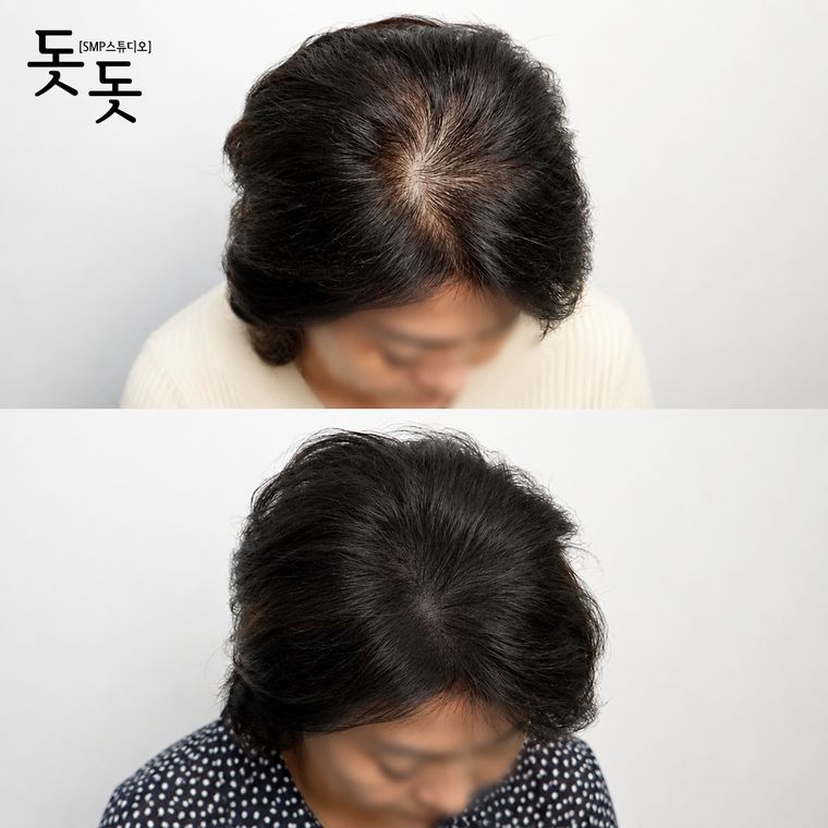 김포두피문신 여성 정수리·가르마 커버 시술 전후 사례
