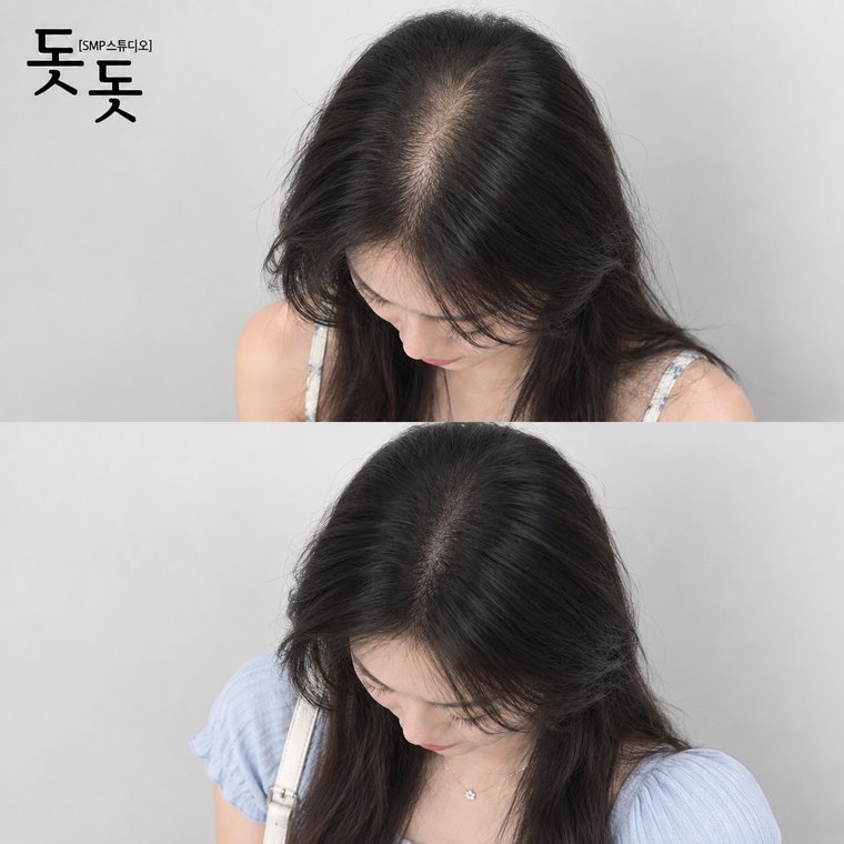 정수리두피문신가격 여성 정수리·가르마 커버 시술 전후 사례