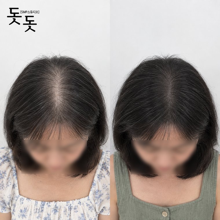 탈모두피문신가격 여성 정수리·가르마 커버 시술 전후 사례