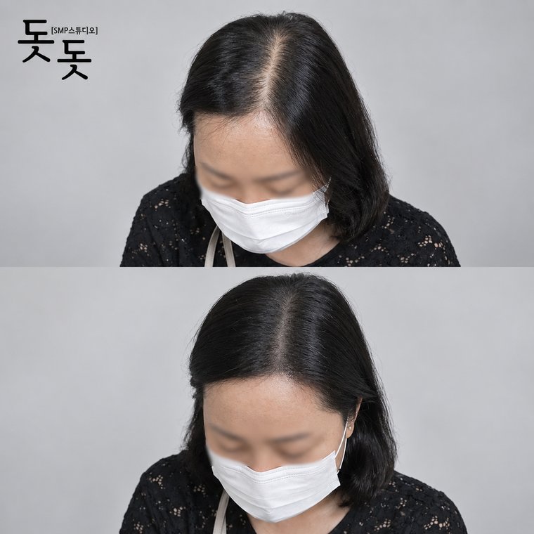 성남두피문신 여성 정수리·가르마 커버 시술 전후 사례