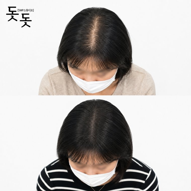 두피타투 여성 정수리·가르마 커버 시술 전후 사례