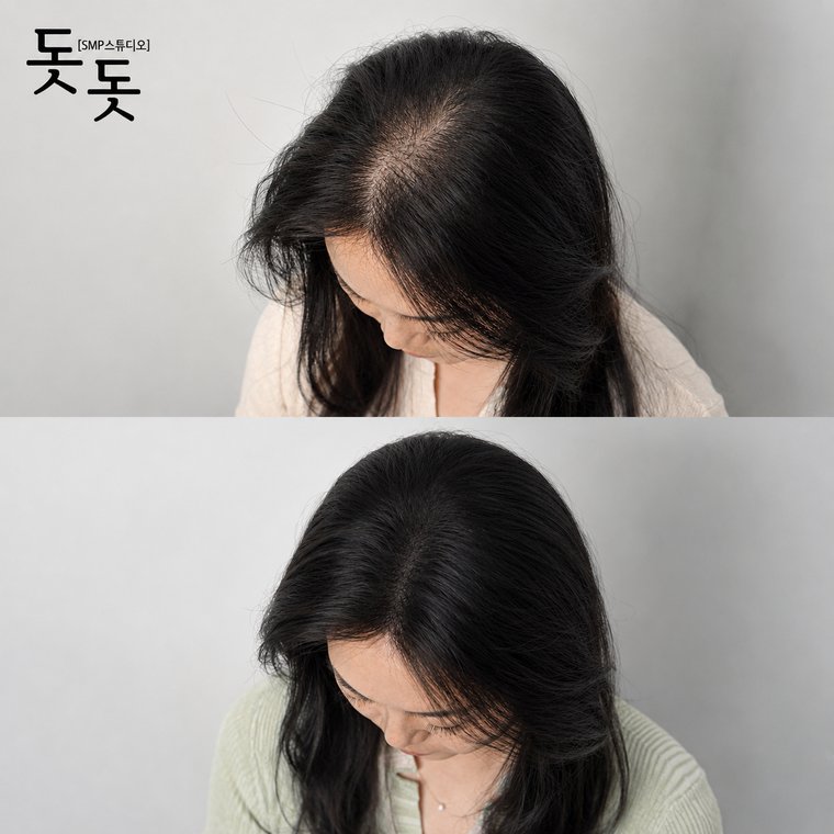 검암두피문신 여성 정수리·가르마 커버 시술 전후 사례