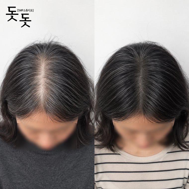 두피문신흰머리 여성 정수리·가르마 커버 시술 전후 사례