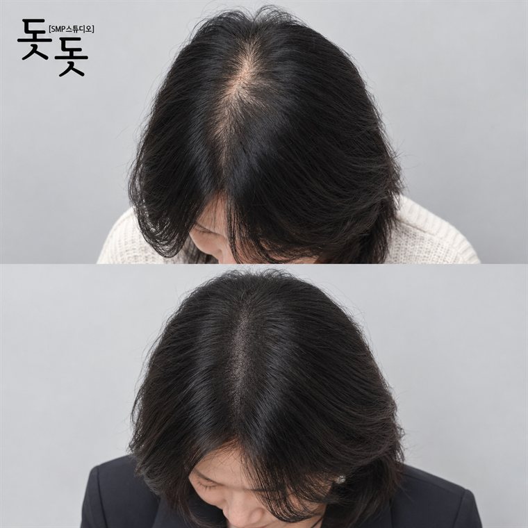 여성 정수리·가르마 두피문신 전후 사례 69