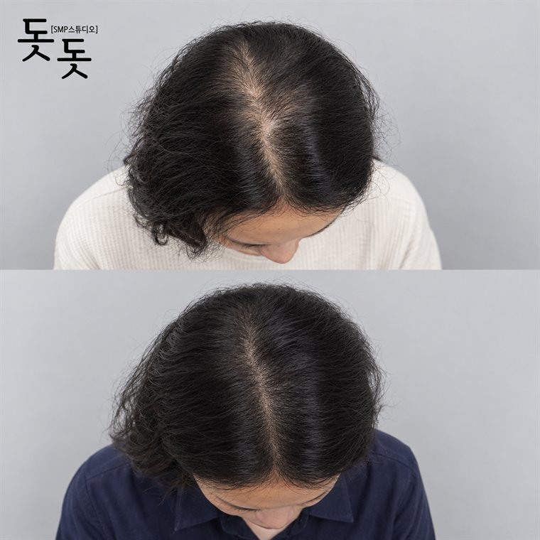 여성 정수리·가르마 두피문신 전후 사례 70