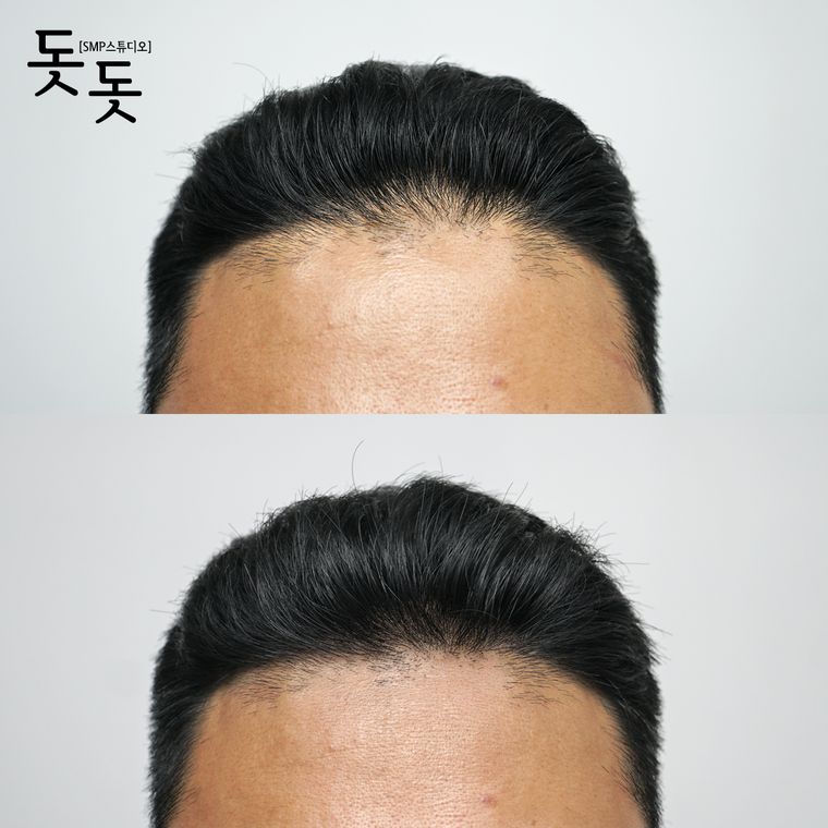 헤어라인 두피문신 전후 사례 2