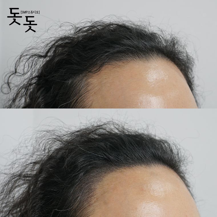 헤어라인 두피문신 전후 사례 7