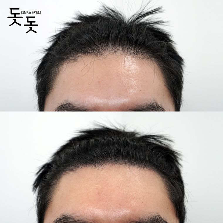 헤어라인 두피문신 전후 사례 8