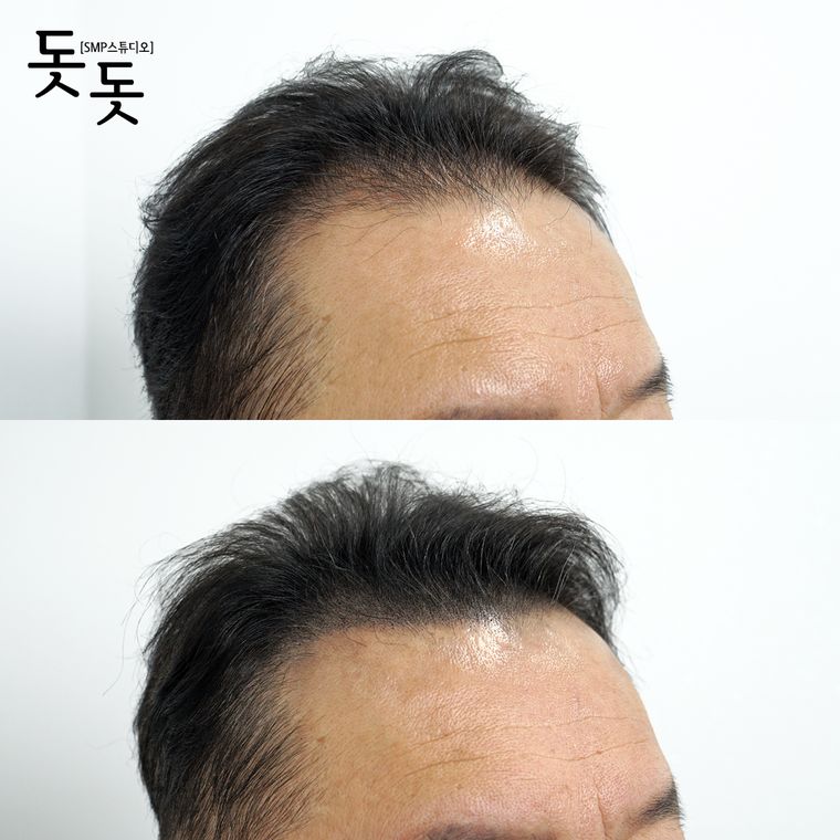 헤어라인 두피문신 전후 사례 18