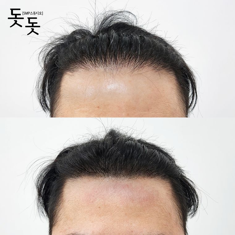 헤어라인 두피문신 전후 사례 19