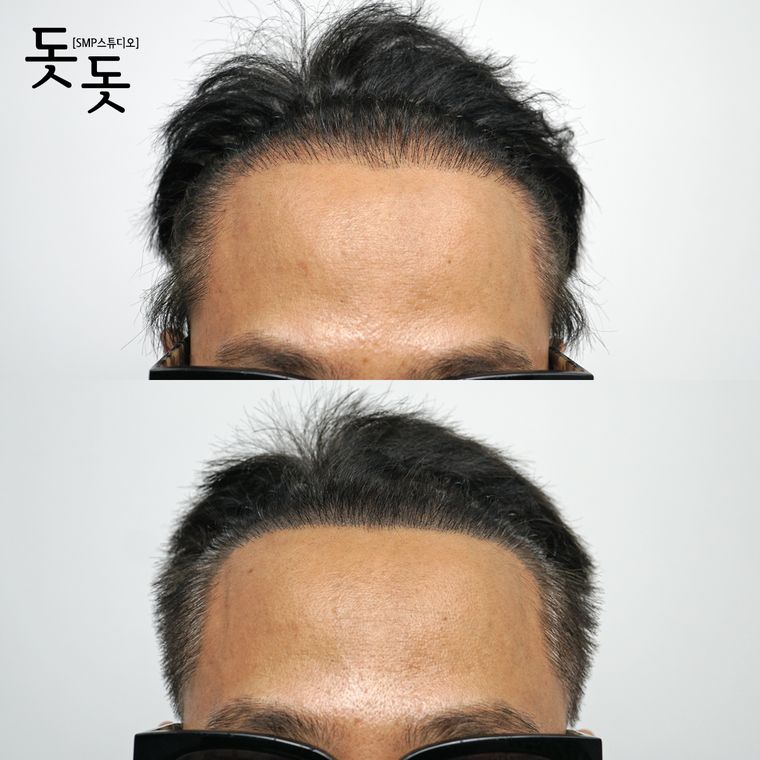 헤어라인 두피문신 전후 사례 25