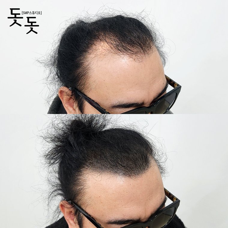 삼송두피문신 헤어라인 디자인 시술 전후 사례