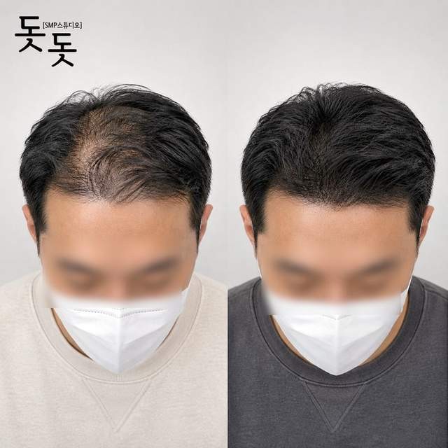 남성 정수리 두피문신 전후 사례 1