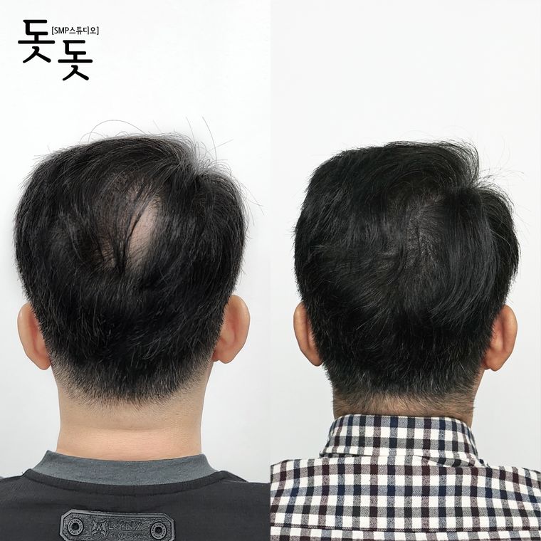 남성 정수리 두피문신 전후 사례 3