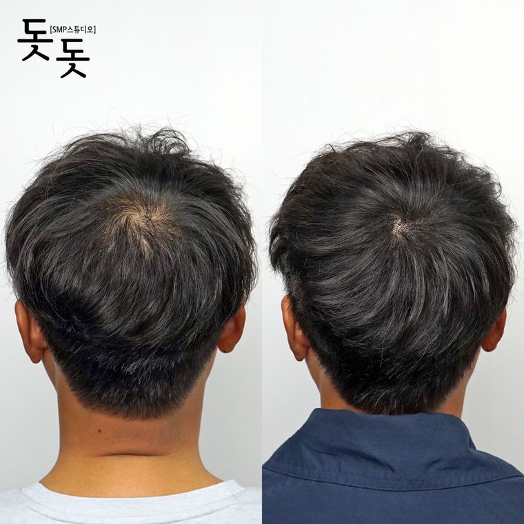 남성 정수리 두피문신 전후 사례 6