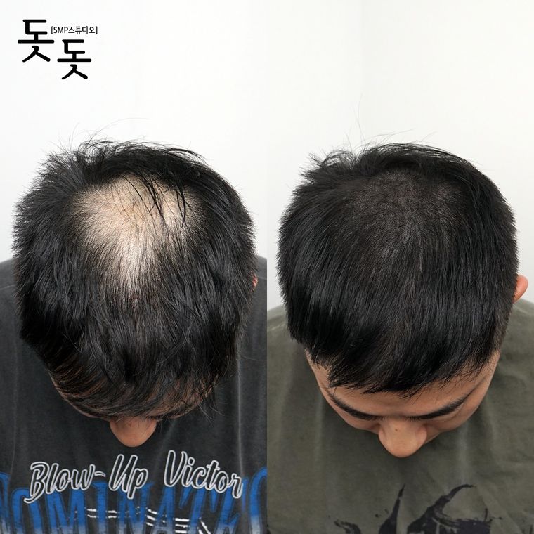 남성 정수리 두피문신 전후 사례 7