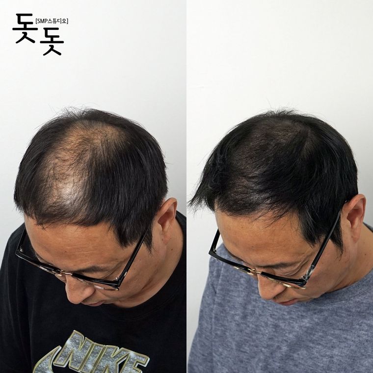 남성 정수리 두피문신 전후 사례 8