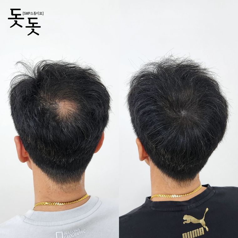 남성 정수리 두피문신 전후 사례 9