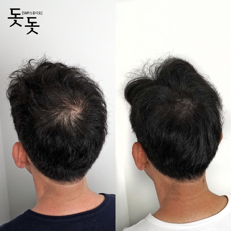 남성 정수리 두피문신 전후 사례 10
