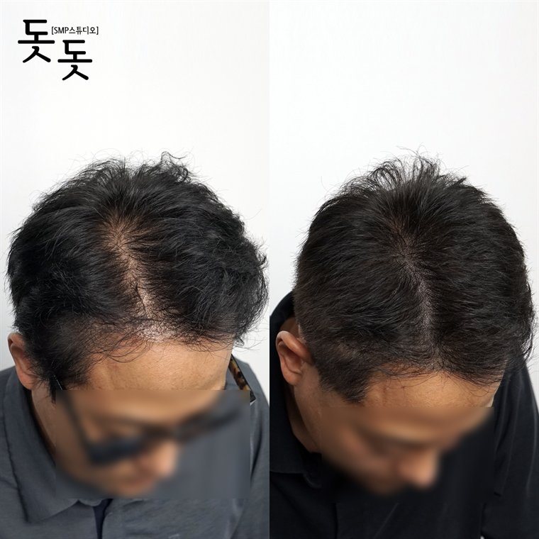 남성 정수리 두피문신 전후 사례 105