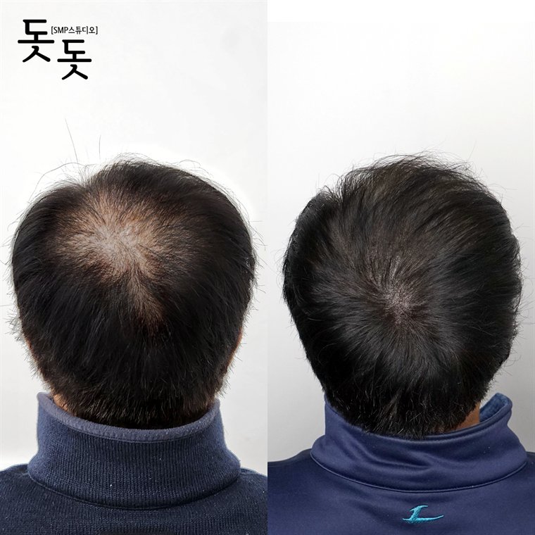 남성 정수리 두피문신 전후 사례 107
