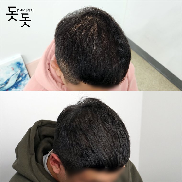 남성 정수리 두피문신 전후 사례 109
