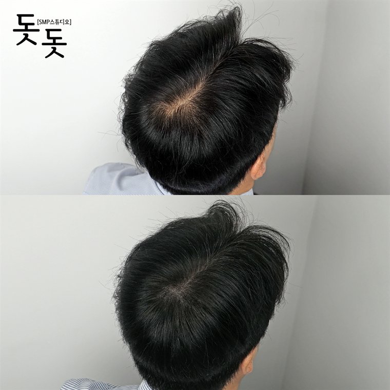 남성 정수리 두피문신 전후 사례 111