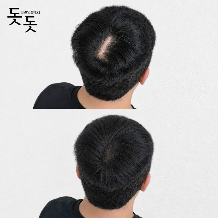 남성 정수리 두피문신 전후 사례 12