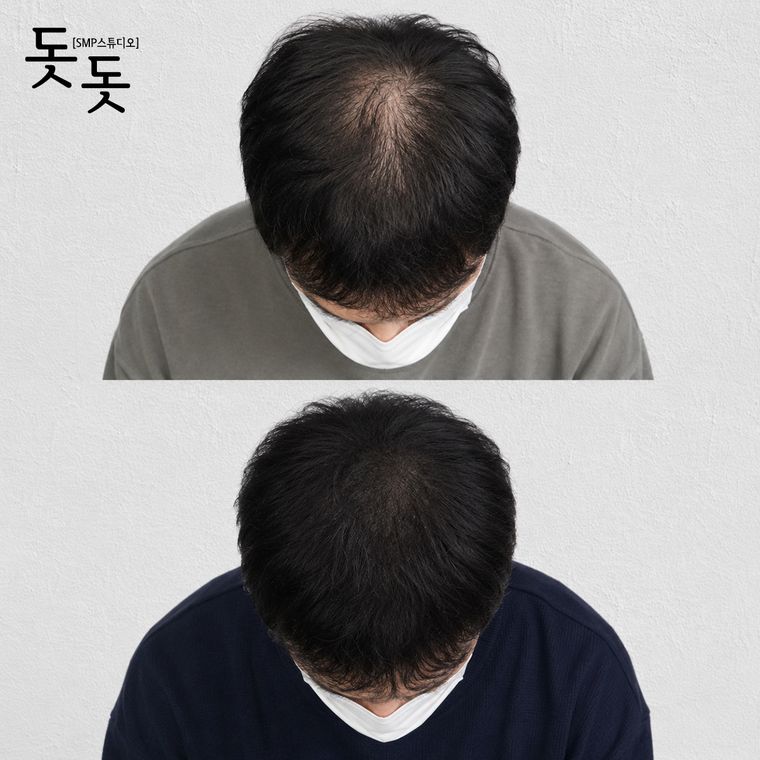 남성 정수리 두피문신 전후 사례 13