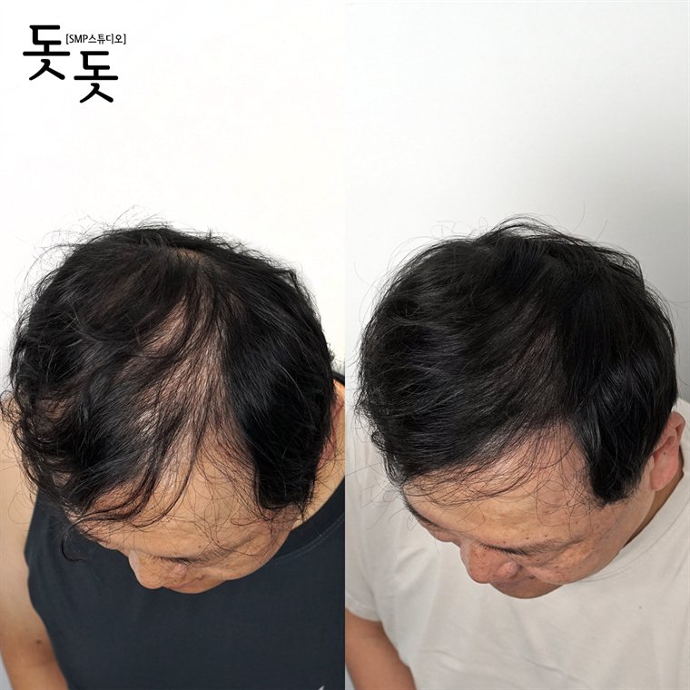 남성 정수리 두피문신 전후 사례 132