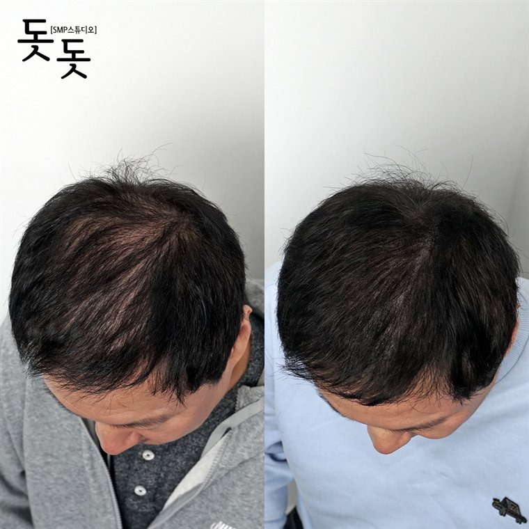 남성 정수리 두피문신 전후 사례 138